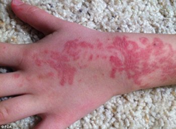 Ouch: A five-year-old developed severe reddening where the black henna tattoo was placed, pictured
